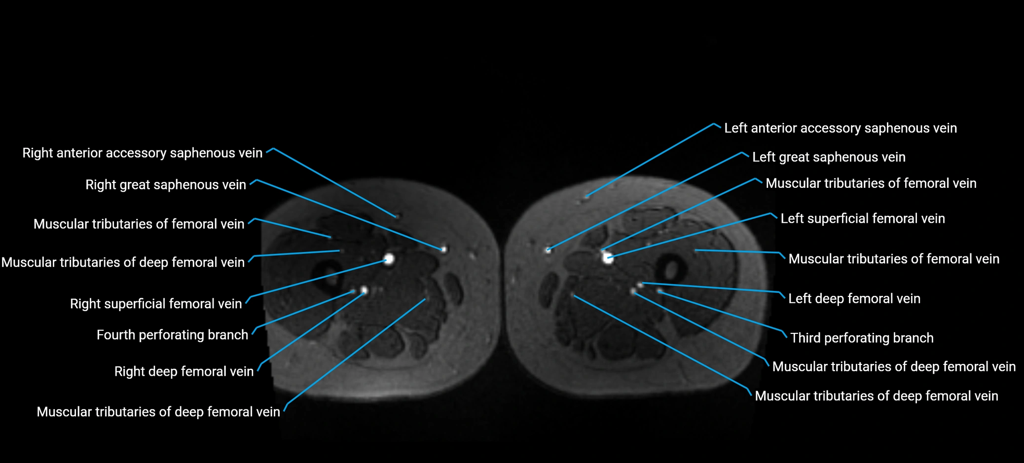 MRV abdomen pelvis & lower limb axial cross sectional anatomy labelled MRI image 253 (1).webp